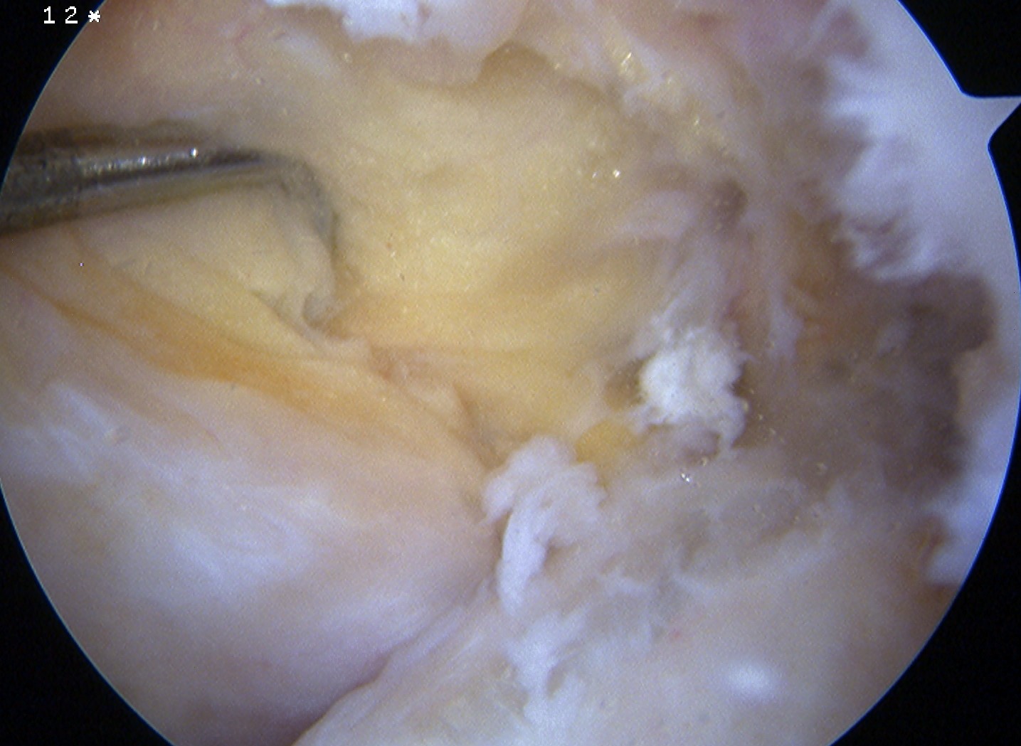 PCL Torn Arthroscopy 2